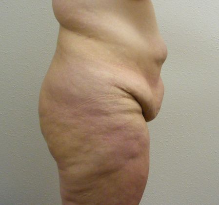 Massive Weight Loss : Case 5 - Massive Weight Loss Before