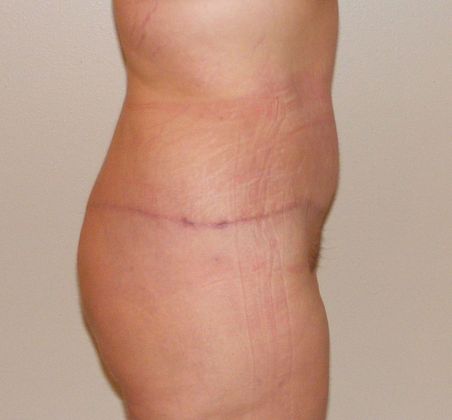 Massive Weight Loss : Case 5 - Massive Weight Loss After