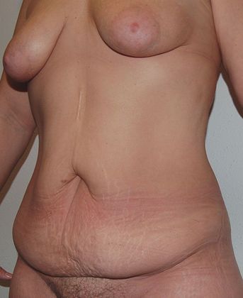 Massive Weight Loss : Case 6 - Massive Weight Loss Before