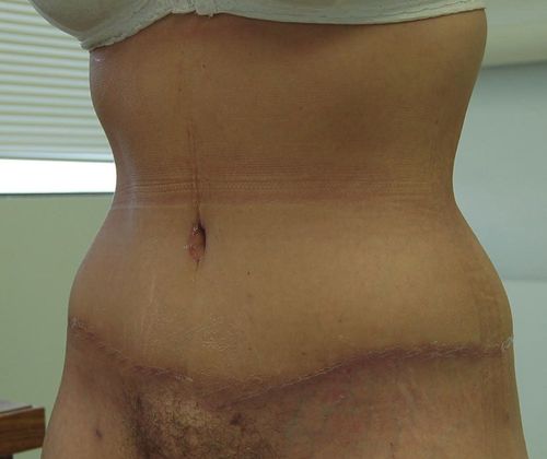 Massive Weight Loss : Case 6 - Massive Weight Loss After