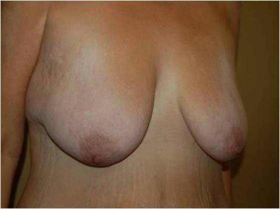 Massive Weight Loss : Case 7 - Massive Weight Loss Before