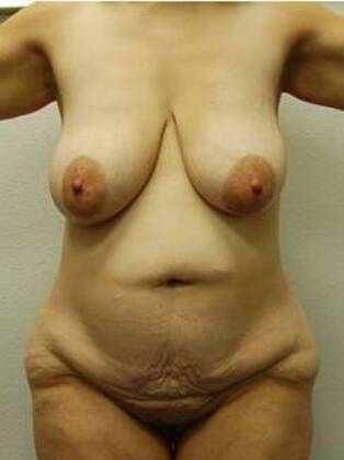 Massive Weight Loss : Case 331 - Massive Weight Loss Before