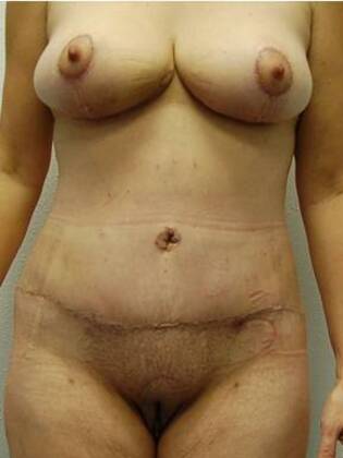 Massive Weight Loss : Case 331 - Massive Weight Loss After