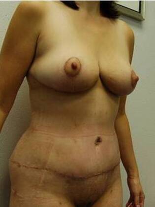 Massive Weight Loss : Case 331 - Massive Weight Loss After