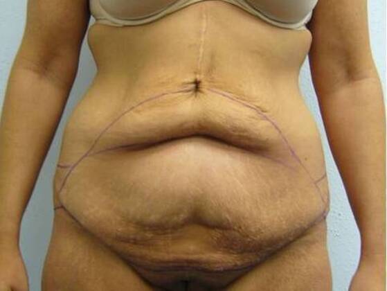 Massive Weight Loss  Case 9 - Before