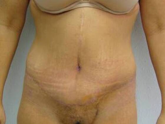 Massive Weight Loss  Case 9 - After