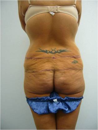 Massive Weight Loss : Case 9 - Massive Weight Loss Before