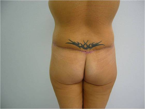 Massive Weight Loss : Case 9 - Massive Weight Loss After