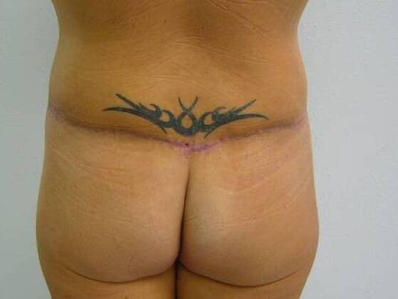 Massive Weight Loss : Case 9 - Massive Weight Loss After