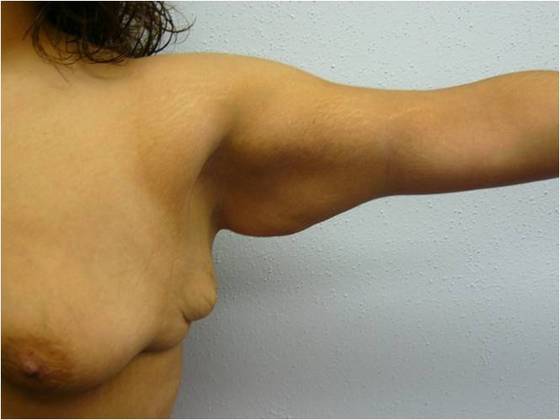 Brachioplasty Case 2 - Before