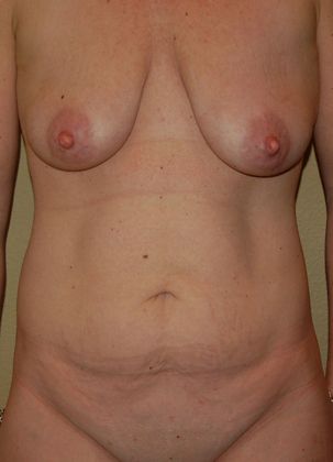 Mommy Makeover Case 3 - Before