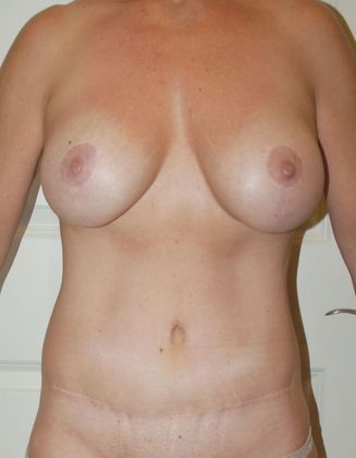 Mommy Makeover Case 3 - After