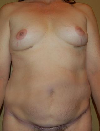 Mommy Makeover Case 21 - Before