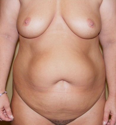 Mommy Makeover Case 81 - Before