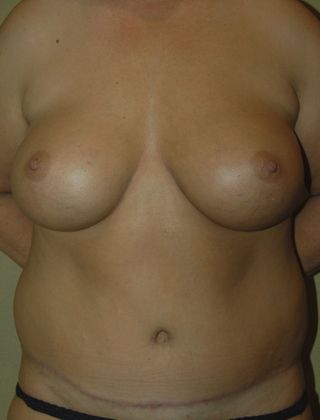 Mommy Makeover Case 81 - After