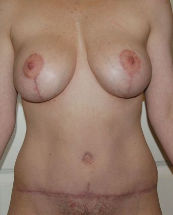 Mommy Makeover Case 7 - After