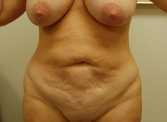 Mommy Makeover Case 8 - Before