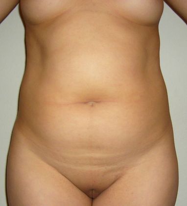 Mommy Makeover Case 272 - Before