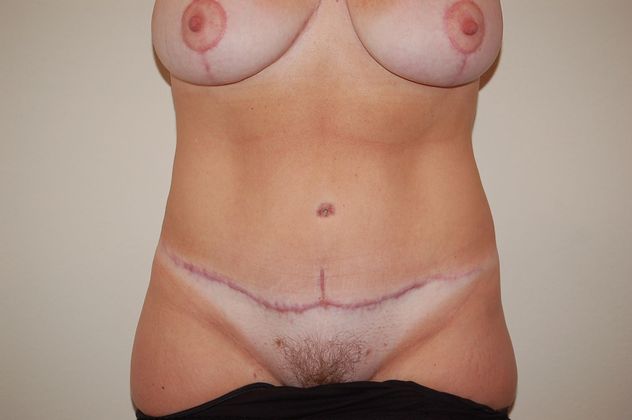 Mommy Makeover Case 11 - After