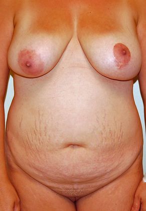 Mommy Makeover Case 12 - Before