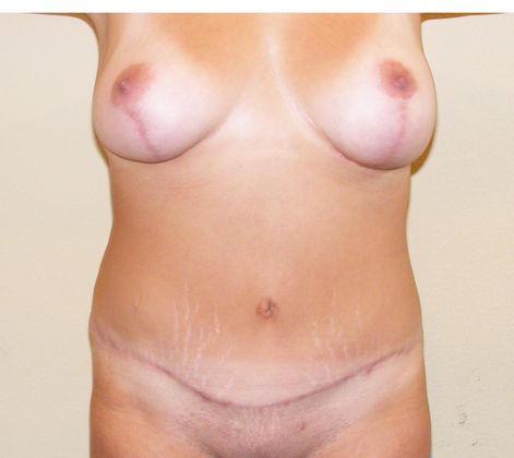 Mommy Makeover Case 12 - After