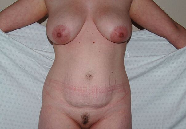 Mommy Makeover Case 349 - Before