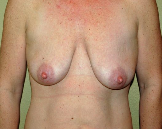 Mommy Makeover: Case 15 - Mommy Makeover Before