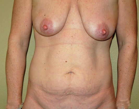 Mommy Makeover Case 15 - Before