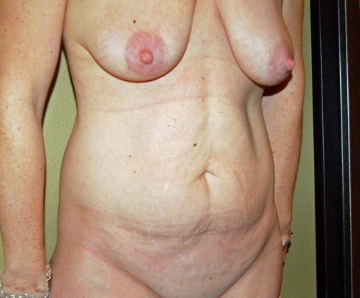 Mommy Makeover: Case 15 - Mommy Makeover Before