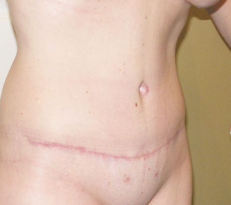 Mommy Makeover: Case 15 - Mommy Makeover After