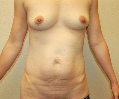 Mommy Makeover Case 16 - Before