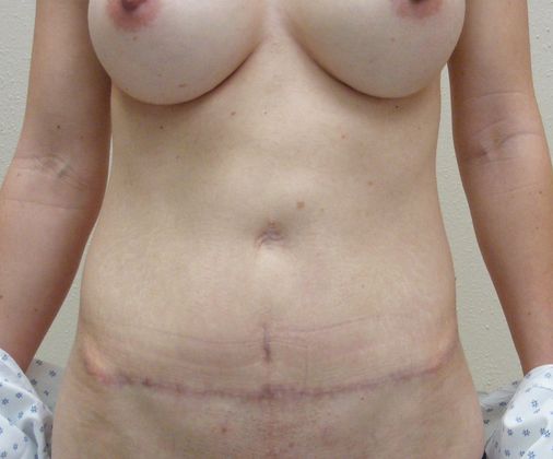 Mommy Makeover Case 16 - After