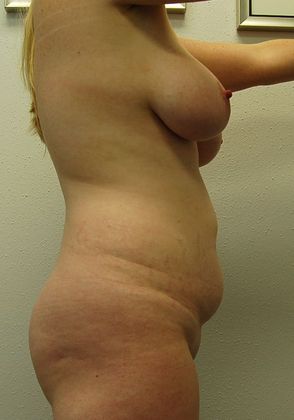 Mommy Makeover: Case 358 - Mommy Makeover Before