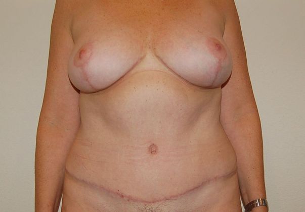 Mommy Makeover Case 18 - After