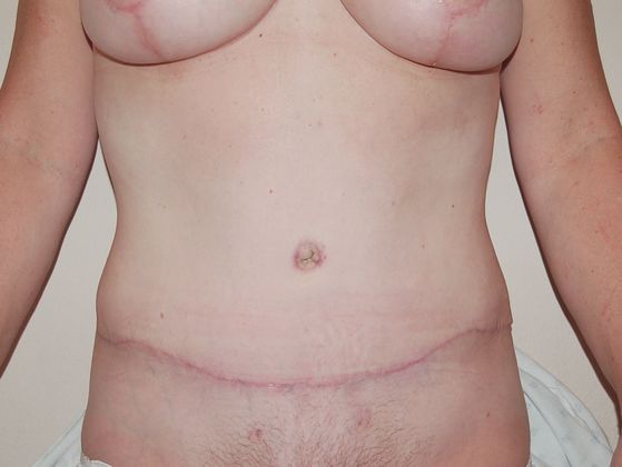 Mommy Makeover Case 20 - After