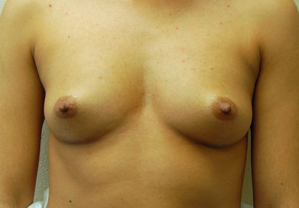 Breast Augmentation Case 51 - Before