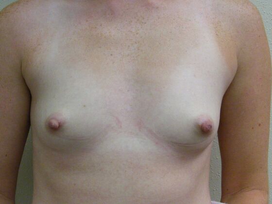 Breast Augmentation: Case 52 - Before Breast Augmentation