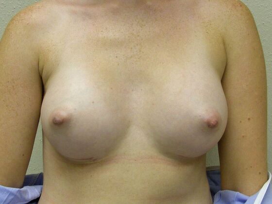 Breast Augmentation: Case 52 - After Breast Augmentation
