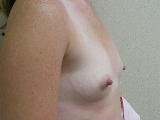 Breast Augmentation: Case 52 - Before Breast Augmentation