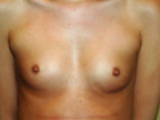 Breast Augmentation: Case 54 - Before Breast Augmentation