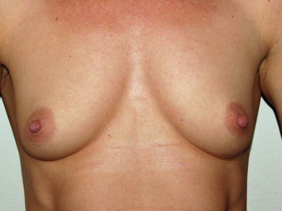 Breast Augmentation: Case 57 - Before Breast Augmentation