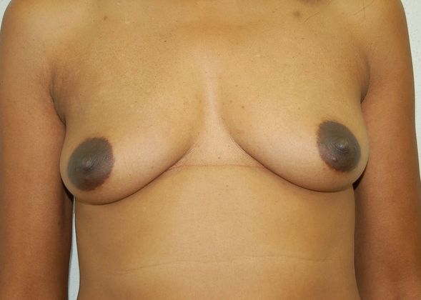 Breast Augmentation Case 58 - Before