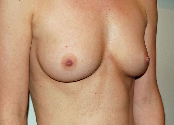 Breast Augmentation: Case 59 - Before Breast Augmentation