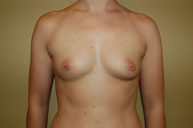Breast Augmentation Case 65 - Before