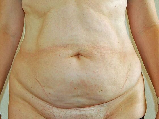 Tummy Tuck (Abdominoplasty) Case 7 - Before