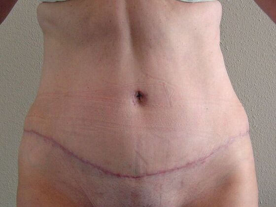 Tummy Tuck (Abdominoplasty) Case 7 - After