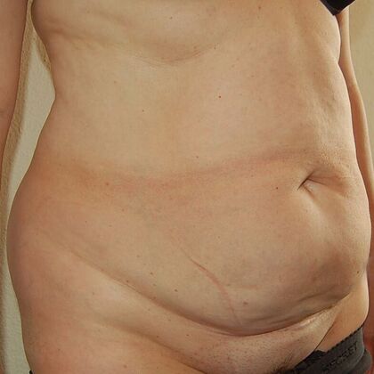 Tummy Tuck (Abdominoplasty): Case 7 - Tummy Tuck Before
