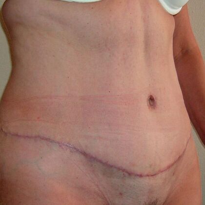 Tummy Tuck (Abdominoplasty): Case 7 - Tummy Tuck After
