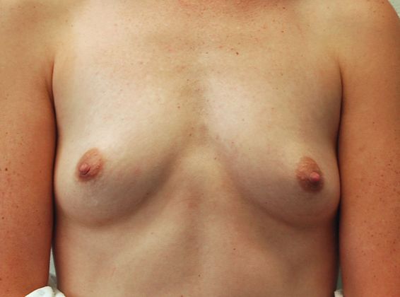 Breast Augmentation Case 68 - Before