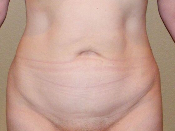 Tummy Tuck (Abdominoplasty) Case 8 - Before